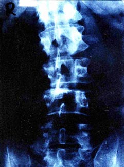 X Ray - polio back